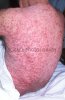 M2400487-Purpura_rash-SPL.jpg M2400487-Purpura_rash-SPL.jpg